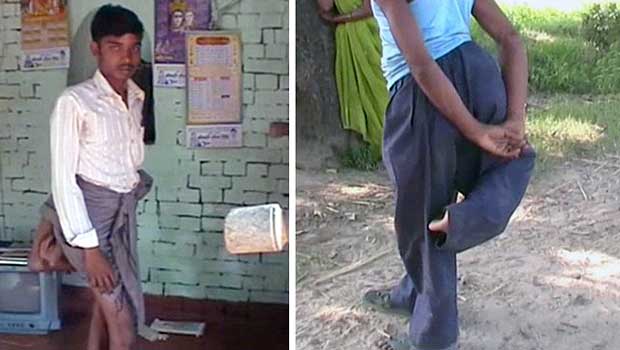 Indian Man Born With Four Legs Declared a Devil