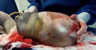 Incredible Video of Baby Born inside Amniotic Sac Goes Viral